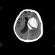 Intracerebral hemorhage, hemocephalus, artifact from malfunctioning detector: CT - Computed tomography